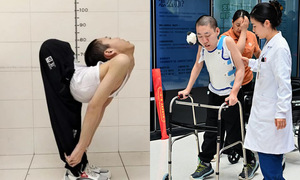 Man with z-shaped spine walks after 20 years