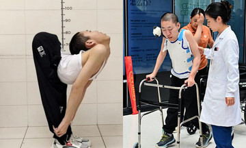 Man with z-shaped spine walks after 20 years