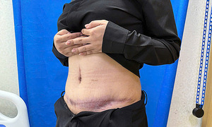 Abdominal deformity after scar treatment injection following liposuction