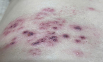 Shingles after long work deadlines