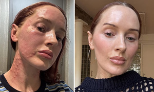 American women endure hundreds of injections for 'glass skin'
