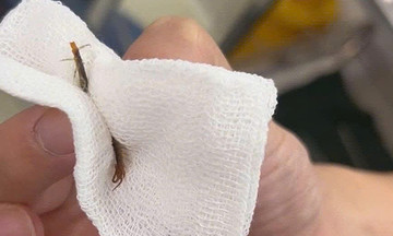 5cm centipede removed from man's ear