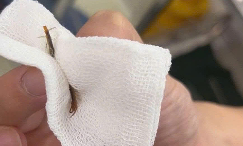5cm centipede removed from man's ear