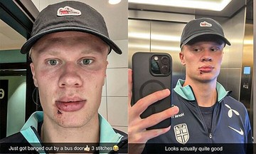 Haaland suffers lip injury in bus mishap