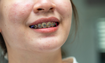 Necessary precautions before getting braces