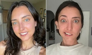 Actress's sudden facial paralysis after strange tongue sensation