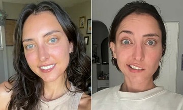 Actress's sudden facial paralysis after strange tongue sensation