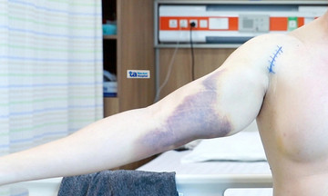 Gym injuries: When workouts go wrong