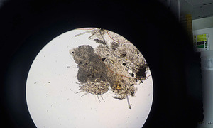 Dozens of lice infest woman's eyelashes