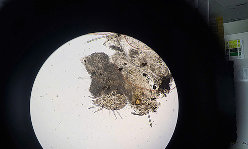 Dozens of lice infest woman's eyelashes
