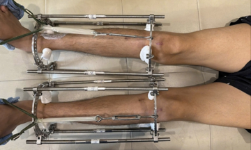 The truth behind limb lengthening surgery