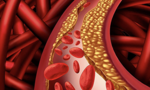 Signs of high cholesterol