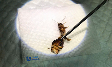 Cockroach removed from man's ear