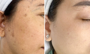 Postpartum freckling: A common skin concern