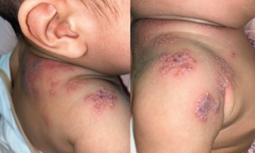 Shingles in children: a 'geriatric disease' not just for the elderly