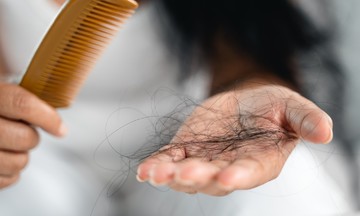 Why does hair fall out after dengue fever?
