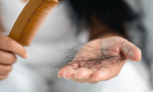 Why does hair fall out after dengue fever?