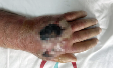 Shop owner's arm saved after thief's bite causes severe infection