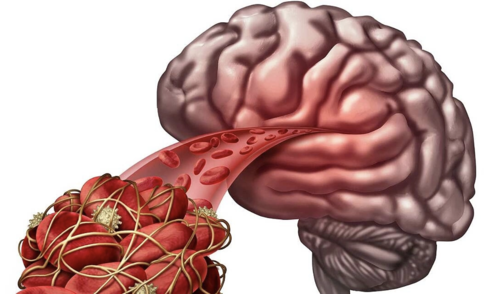 7 subtle signs of blood clots you shouldn't ignore