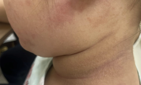 4 common skin conditions in children