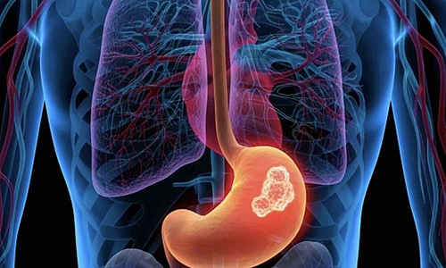 Stomach cancer hidden behind indigestion