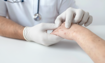 Recognizing warts caused by HPV