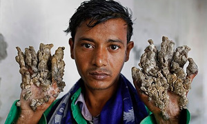 ‘Tree man’ syndrome: A decade without touch
