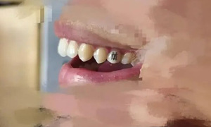 Tooth tattoos: The latest trend among Chinese youth