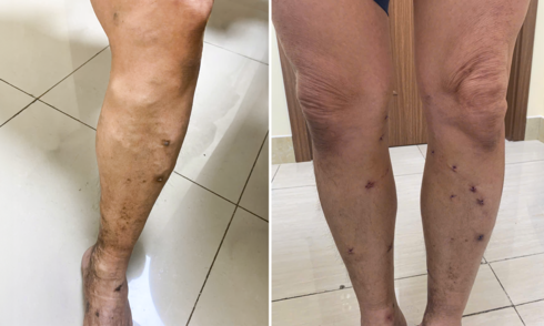 Biological glue injection treats varicose veins