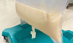 Man's blood plasma turns milky white due to extremely high triglyceride levels