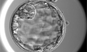 Infertility caused by 90% abnormal eggs