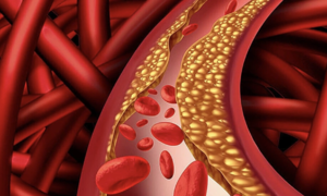 High blood fat: a 'silent killer' affecting young people