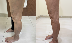 Sclerotherapy treatment for varicose veins in people with diabetes