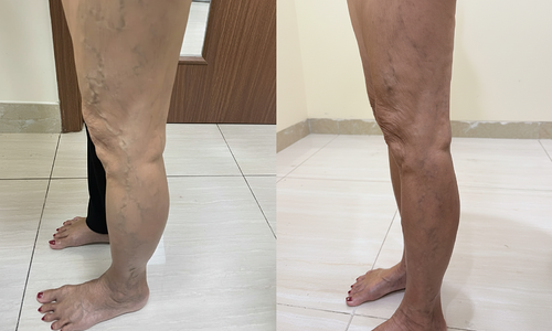 Sclerotherapy treatment for varicose veins in people with diabetes