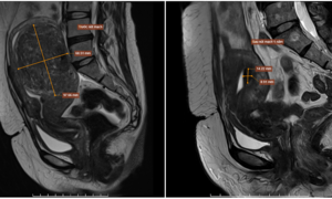 Uterine fibroids shrink after embolization