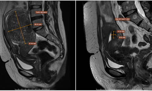 Uterine fibroids shrink after embolization