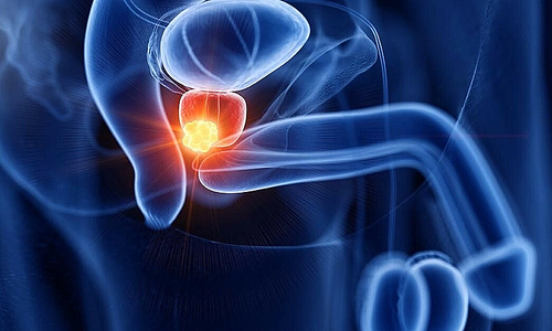 Who is susceptible to prostate cancer?