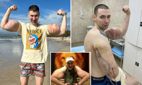 Russian bodybuilder at risk of double arm amputation due to chemical injections
