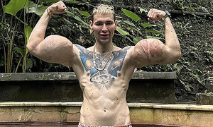 Russian 'gym monster' pays the price for 61 cm bicep injections