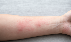 Signs of iodine deficiency you shouldn't ignore