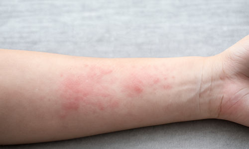 Signs of iodine deficiency you shouldn't ignore