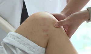 Pneumonia from chickenpox complications