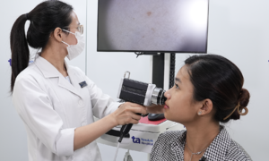 4 mistakes causing persistent acne