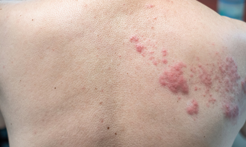 Shingles recurs after five years