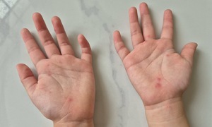 Hand, foot, and mouth disease cases surge as severe virus strain re-emerges