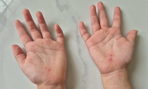 Hand, foot, and mouth disease cases surge as severe virus strain re-emerges