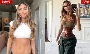 Enduring pain to cut ribs for an 'ant waist'