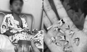 12 decayed teeth extracted simultaneously: the consequence of a bedtime bottle habit