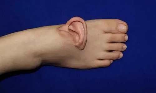Severed ear reattached after five months 'grown' on foot