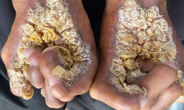 Man diagnosed with 'tree-man syndrome'